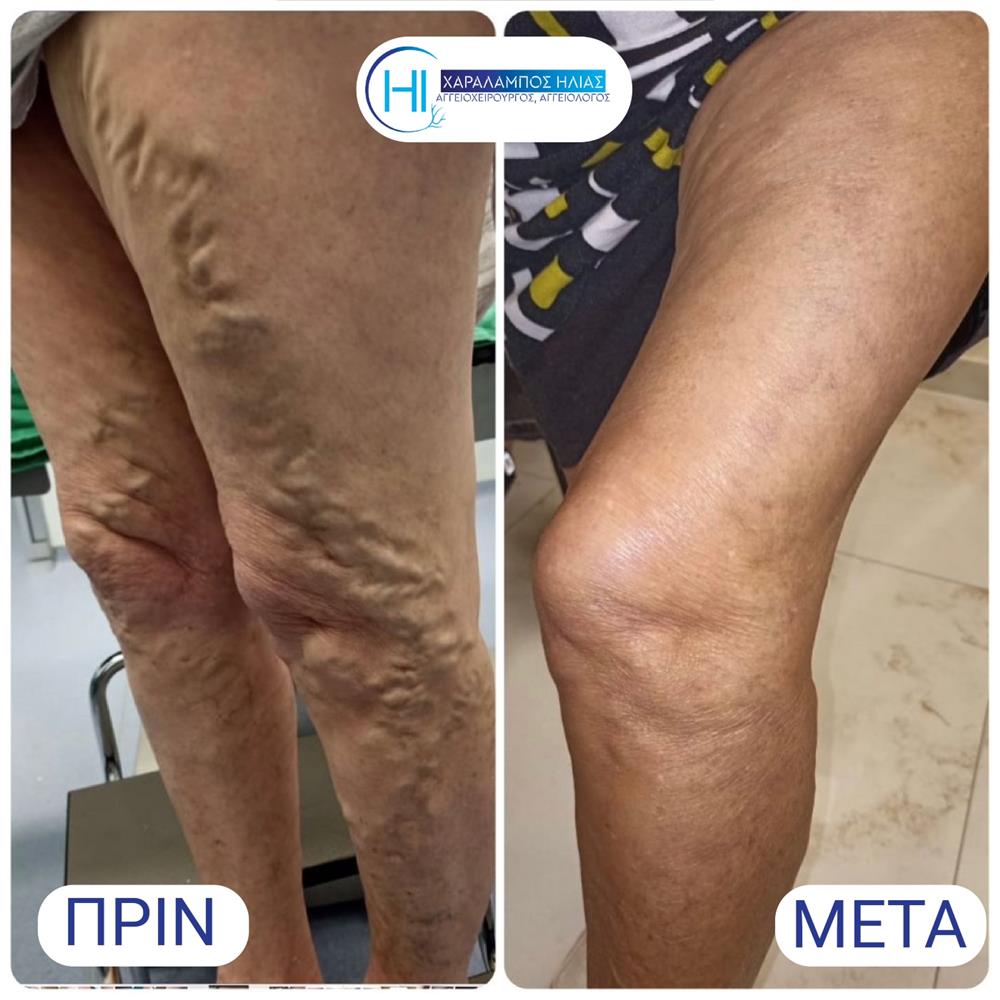 Χαράλαμπος Ηλίας - κιρσοί Χαράλαμπος Ηλίας - κιρσοί