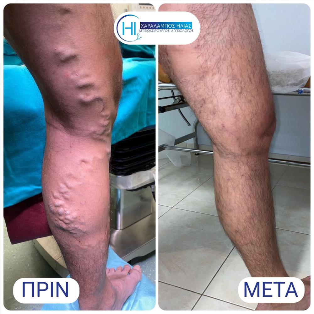 Χαράλαμπος Ηλίας - κιρσοί Χαράλαμπος Ηλίας - κιρσοί