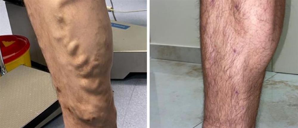 Κιρσοί - ευρυαγγείες Κιρσοί - ευρυαγγείες