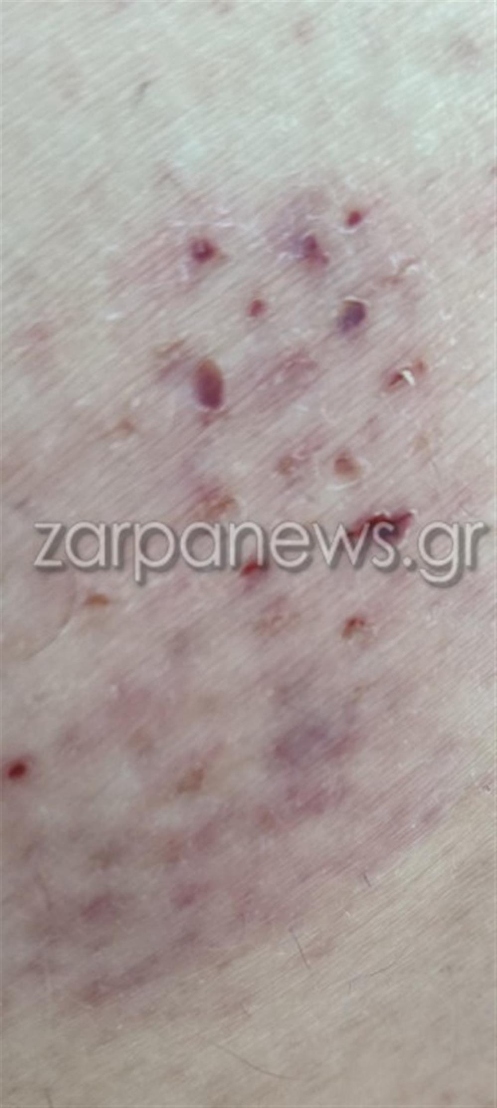 δάγκωμα χελώνας Χανιά