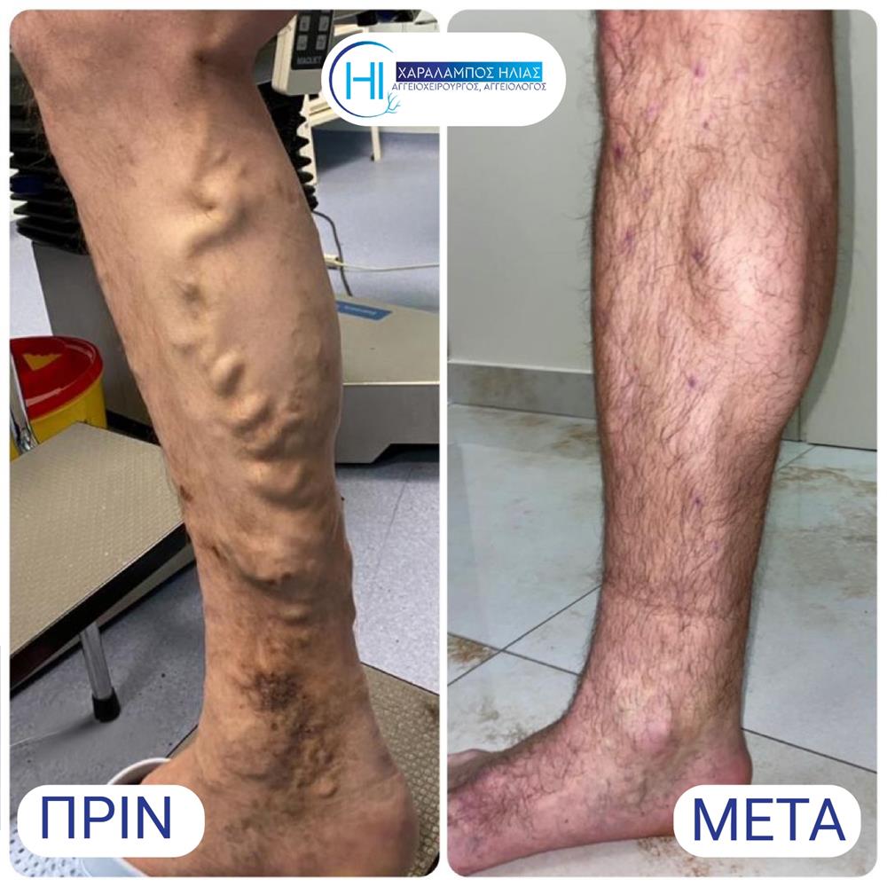 Χαράλαμπος Ηλίας - κιρσοί Χαράλαμπος Ηλίας - κιρσοί