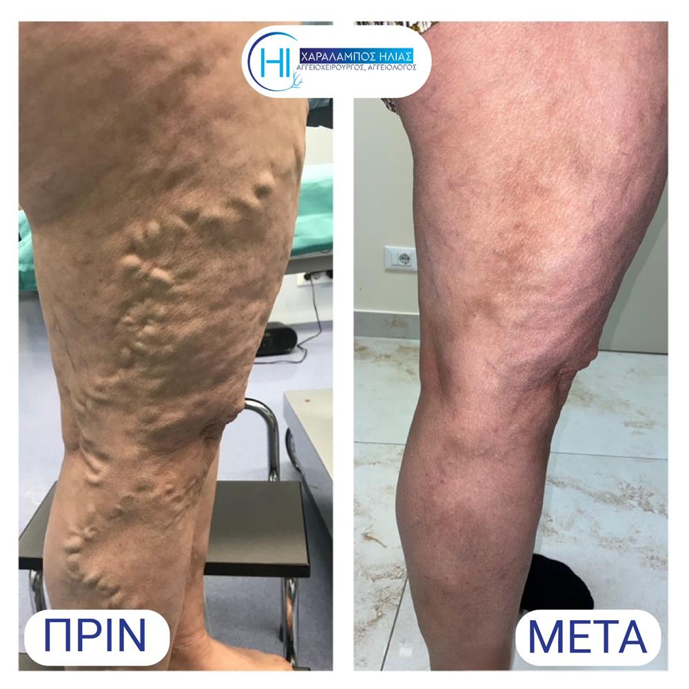 Χαράλαμπος Ηλίας - κιρσοί Χαράλαμπος Ηλίας - κιρσοί