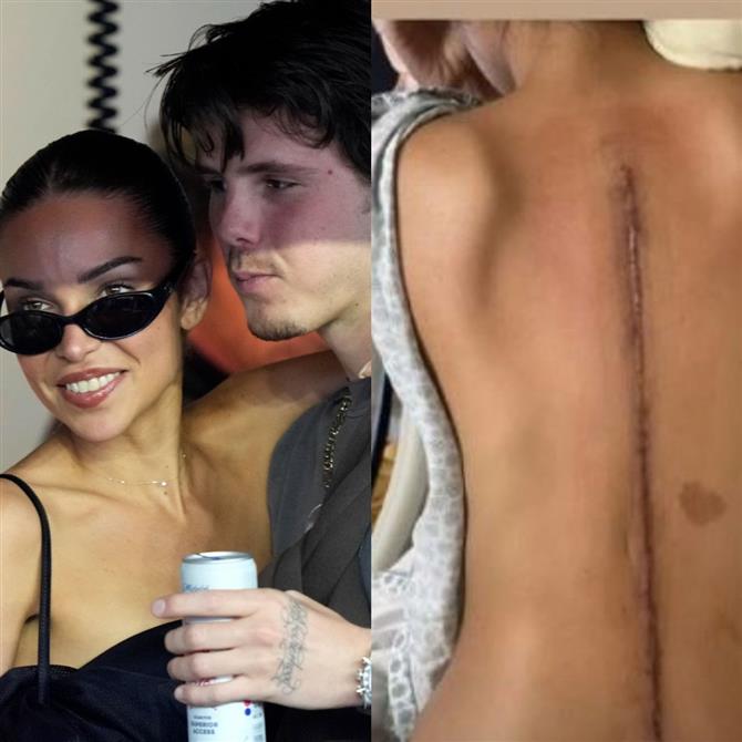 Κρουζ Μπέκαμ: Η σύντροφος του Τζάκι Αποστέλ δείχνει την ουλή στην πλάτη της & αποκαλύπτει πως έμαθε να περπατάει ξανά μετά από χειρουργείο